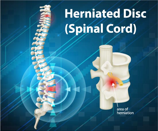 Herniated disc in spinal cord