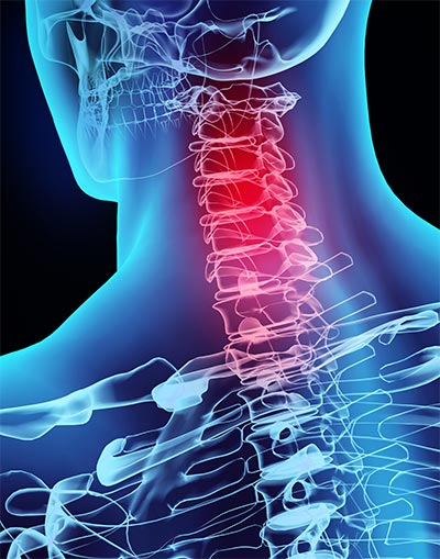 Whiplash injury in neck
